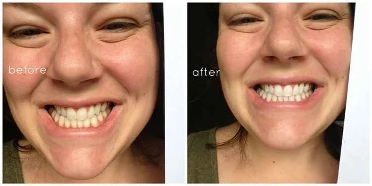 Cara memutihkan gigi secara aman menurut pakar per 2026